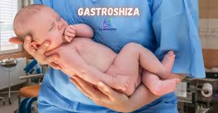 Gastrochisis: A Comprehensive Guide to the Congenital Abdominal Wall Defect Gastrochisis: A Comprehensive Guide to the Congenital Abdominal Wall Defect